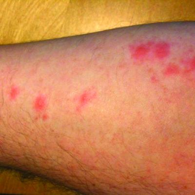 bed bug bite marks in a line 